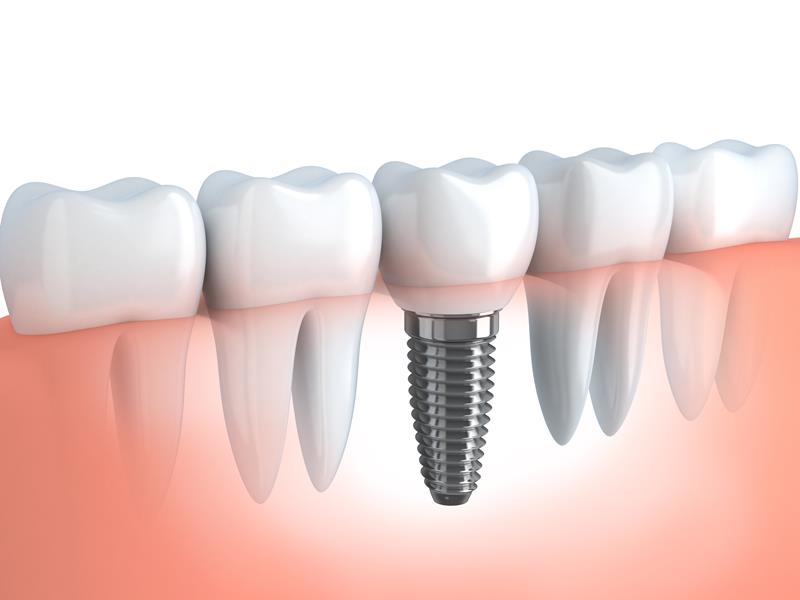 Dental Implants  Hollywood, FL  